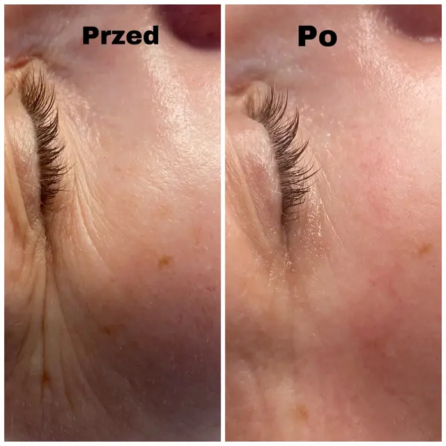 Skóra wokół oka przed zabiegiem i po nim