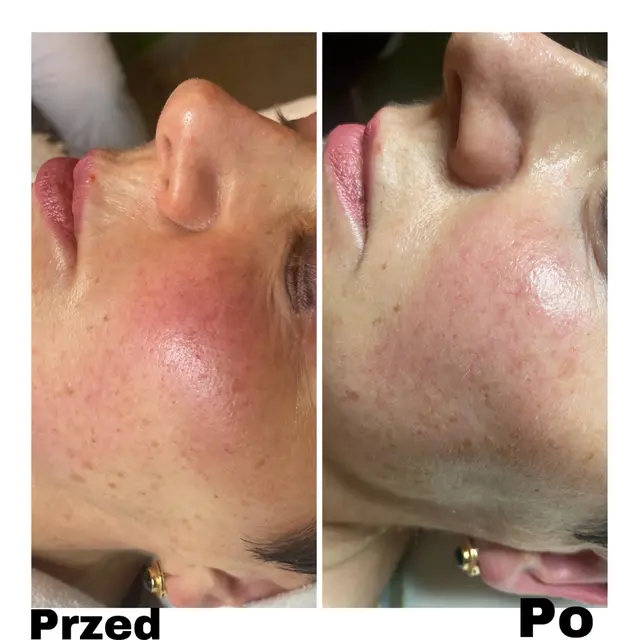 Zaczerwieniona skóra policzka przed zabiegiem i po nim